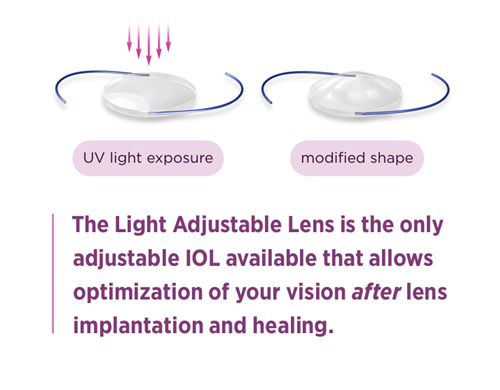 Image of Light Adjustable lens changing chape